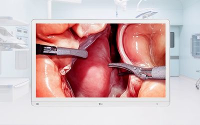 LG predstavlja 4K hirurški monitor sa pametnim funkcijama za  optimizaciju radnog toka u operacionoj sali